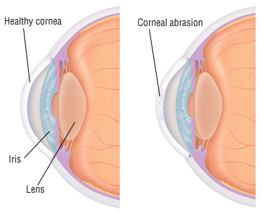 Abrasione corneale Abrasione corneale