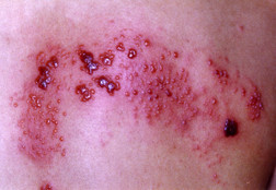 Herpes zoster Herpes zoster
