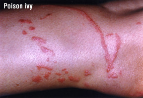 Dermatite da contatto 1