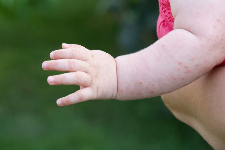 Segni e cause della febbre nei bambini piccoli 11