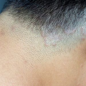 10 cause più comuni di infezioni del cuoio capelluto