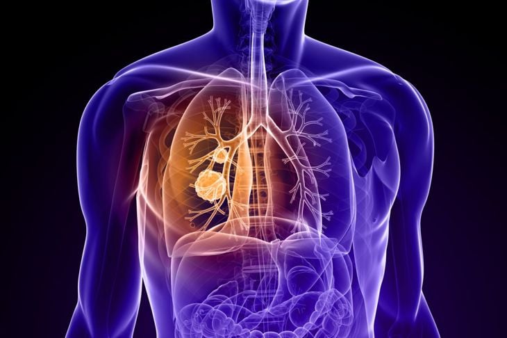 Cosa sono i noduli polmonari? 7