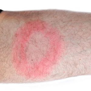10 sintomi della malattia di Lyme 10 sintomi della malattia di Lyme