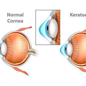 Il cheratocono e il suo effetto sulla visione Il cheratocono e il suo effetto sulla visione