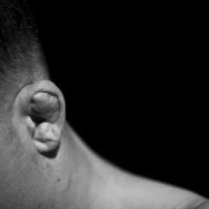 Cause e trattamenti dell’orecchio a cavolfiore