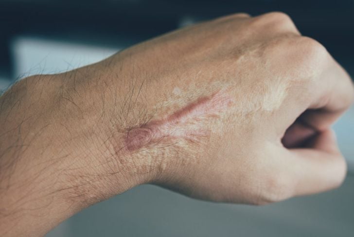 Tipi di tessuto cicatriziale e come prevenirli 3