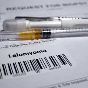 Leiomioma: tumori della muscolatura liscia Leiomioma: tumori della muscolatura liscia