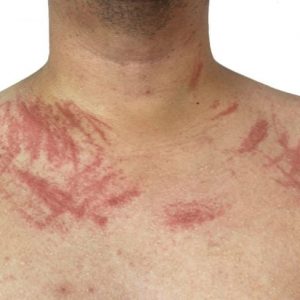 Che cos’è la dermatografia? Che cos’è la dermatografia?