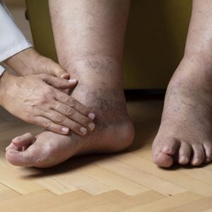 Anasarca: Edema generalizzato Anasarca: Edema generalizzato