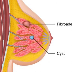 Cosa c’è da sapere sul fibroadenoma non canceroso