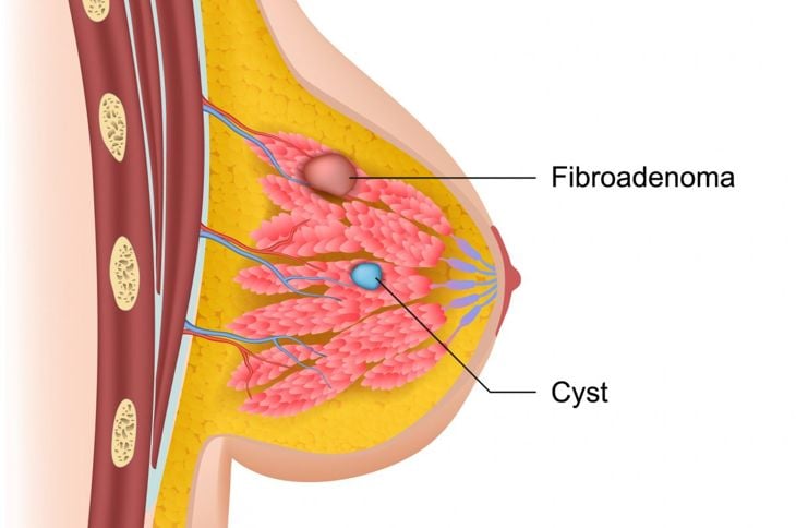 Cosa c'è da sapere sul fibroadenoma non canceroso 1