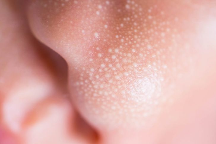 L'acne infantile è un problema comune 19
