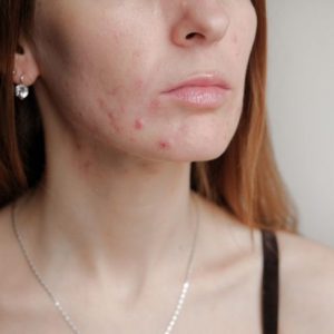 Ridurre la visibilità delle cicatrici da acne Ridurre la visibilità delle cicatrici da acne