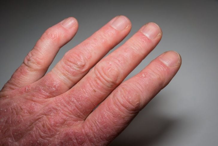10 sintomi dell'artrite psoriasica 9