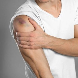 10 sintomi dell’emofilia 10 sintomi dell’emofilia