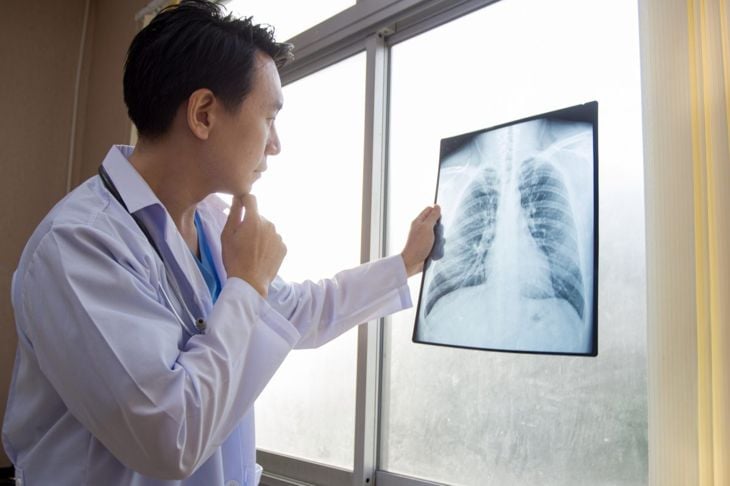 Fibrosi polmonare e cicatrici polmonari 11