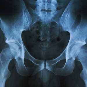 Un dolore inspiegabile alla coscia potrebbe essere una meralgia parestetica Un dolore inspiegabile alla coscia potrebbe essere una meralgia parestetica