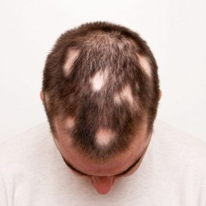 Capire la tricotillomania o il tirarsi i capelli in modo cronico Capire la tricotillomania o il tirarsi i capelli in modo cronico