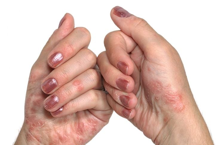 Qual è il problema del prurito alle dita? 5
