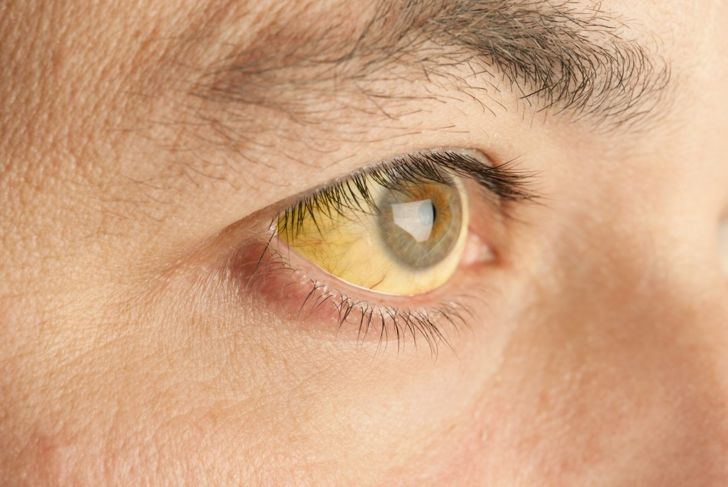 Cause mediche degli occhi gialli 1