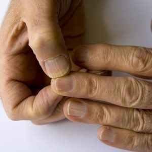 Cosa causa le creste delle unghie?