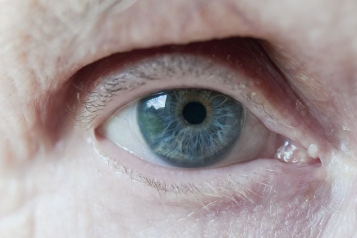 Le numerose cause e i sintomi dell'oftalmoplegia 3