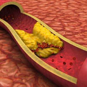 Che cos’è la sindrome di Leriche? Che cos’è la sindrome di Leriche?