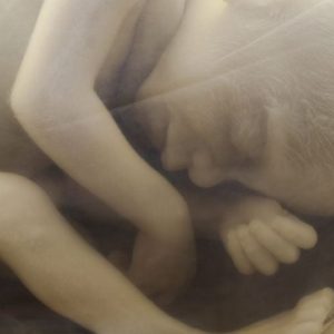 Fatti sulla deformità del varismo