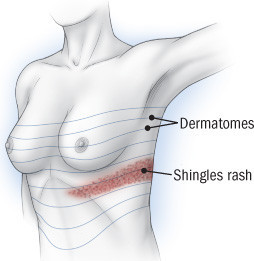 Herpes zoster 6 Herpes zoster 5