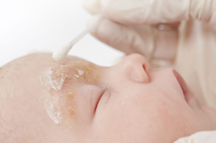 Un'eruzione cutanea sul viso del bambino: Aspettare o preoccuparsi? 7