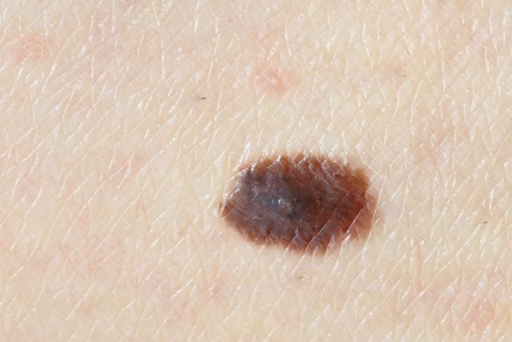 10 sintomi del melanoma 3