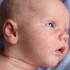 L’acne infantile è un problema comune