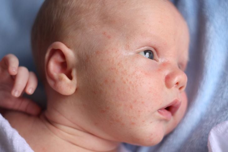 L'acne infantile è un problema comune 1