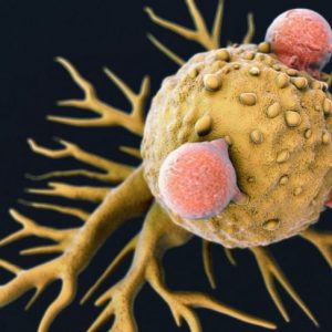 Cosa sono gli istiocitomi fibrosi maligni? Cosa sono gli istiocitomi fibrosi maligni?