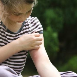 Punture di zanzara gravi: sindrome di Skeeter