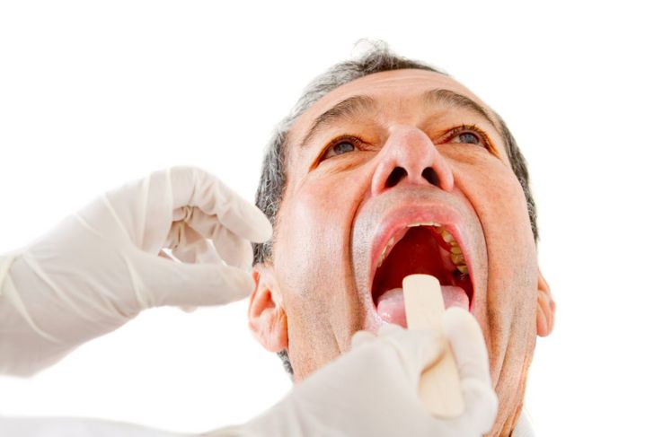 Fatti sugli ascessi tonsillari 3