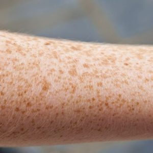 I danni e i benefici dell’abbronzatura I danni e i benefici dell’abbronzatura