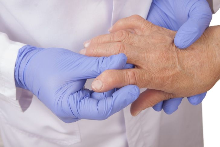 10 sintomi dell'artrite 9