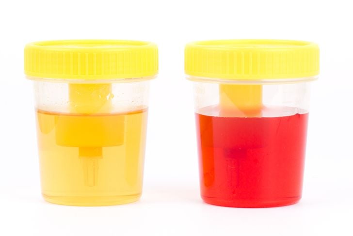 10 domande frequenti sul sangue nelle urine 11