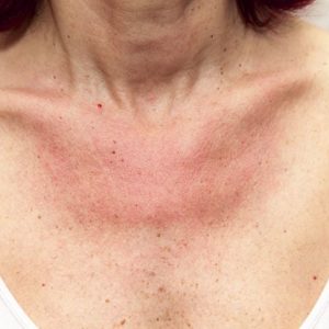 10 sintomi di allergia al lattice