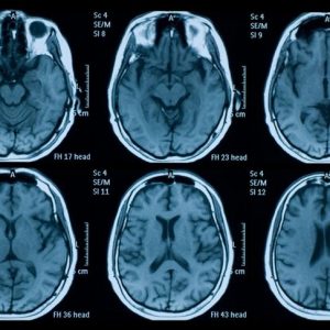 Sindrome di Savant: Abilità notevoli nonostante le limitazioni Sindrome di Savant: Abilità notevoli nonostante le limitazioni