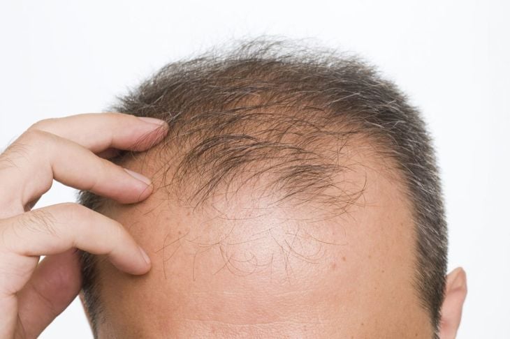 Domande frequenti sulla perdita di capelli diffusa 3