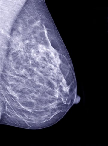Segni del cancro al seno 5