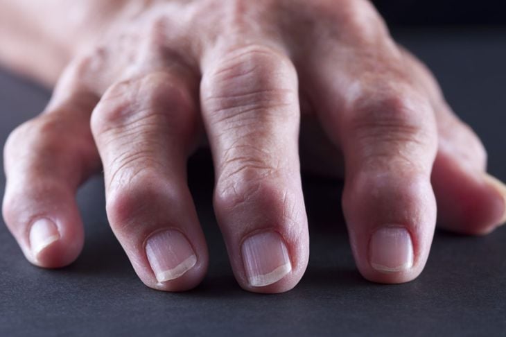 Qual è la differenza tra artrite reumatoide e gotta? 7