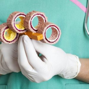 10 sintomi di aterosclerosi 10 sintomi di aterosclerosi