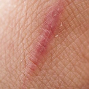 Tipi di tessuto cicatriziale e come prevenirli