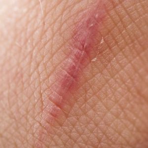 Tipi di tessuto cicatriziale e come prevenirli Tipi di tessuto cicatriziale e come prevenirli