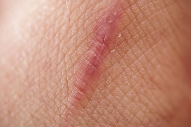 Tipi di tessuto cicatriziale e come prevenirli 1