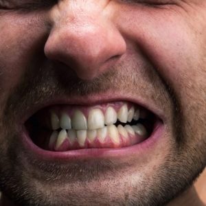 Che cos’è il bruxismo? Che cos’è il bruxismo?