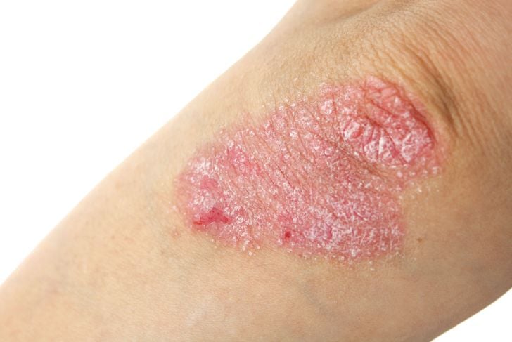 10 cause e fattori scatenanti dell'eczema 11